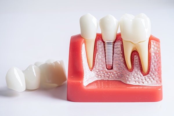 A Dental Crown Overview: What You Need To Know