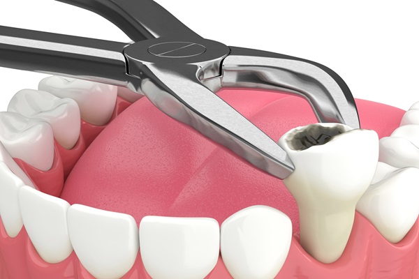 A Dentist Explains The Importance Of A Tooth Extraction